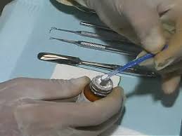 Dental Glass Ionomer Cement